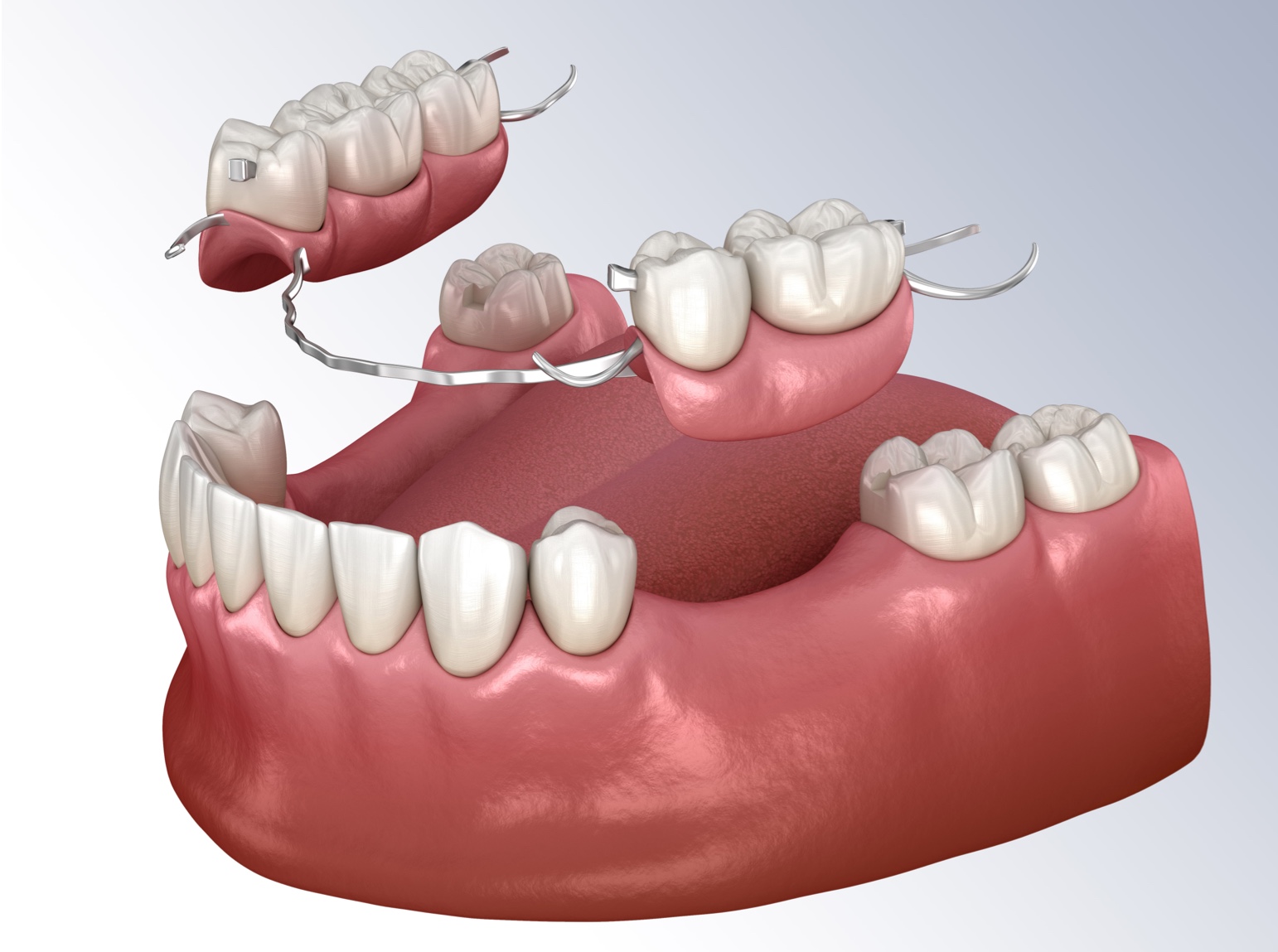 Puente dental parcial removible
