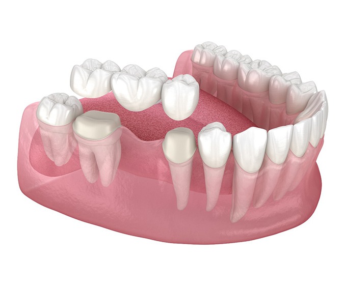 Puente fijo dental